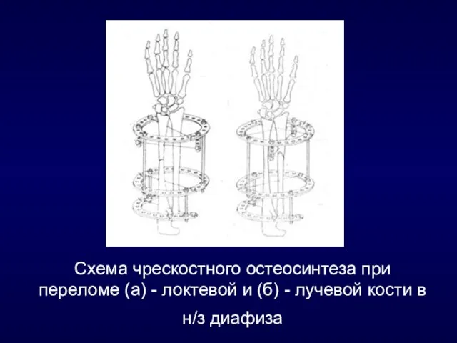 Схема чрескостного остеосинтеза при переломе (а) - локтевой и (б) - лучевой кости в н/з диафиза