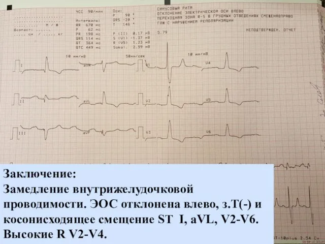 ЭКГ при обычном расположении электродов Заключение: Замедление внутрижелудочковой проводимости. ЭОС отклонена влево,