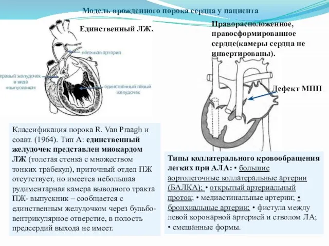 Модель врожденного порока сердца у пациента Праворасположенное, правосформированное сердце(камеры сердца не инвертированы).