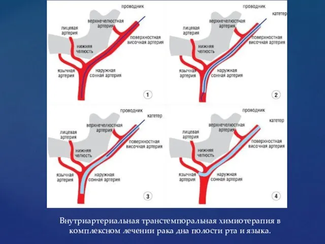 Внутриартериальная транстемпоральная химиотерапия в комплексном лечении рака дна полости рта и языка.