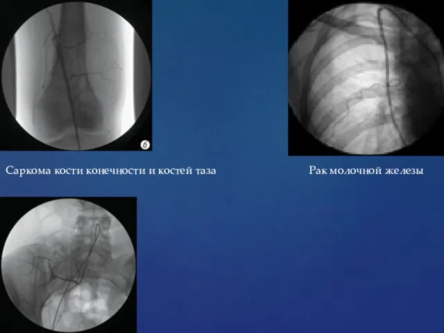 Саркома кости конечности и костей таза Рак молочной железы
