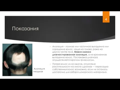 Показания Алопеция – полное или частичное выпадение или поредение волос, чаще на