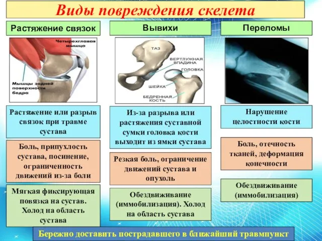 Виды повреждения скелета Растяжение связок Вывихи Переломы Боль, отечность тканей, деформация конечности