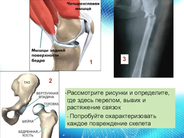 1 2 Рассмотрите рисунки и определите, где здесь перелом, вывих и растяжение