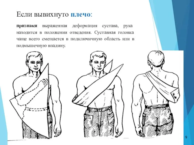 Если вывихнуто плечо: признаки выраженная деформация сустава, рука находится в положении отведения.