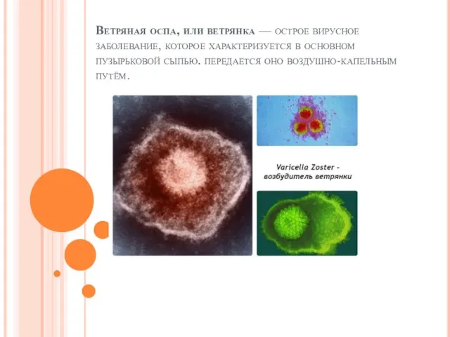 Ветряная оспа, или ветрянка — острое вирусное заболевание, которое характеризуется в основном