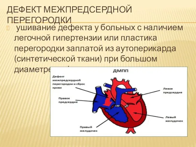 ДЕФЕКТ МЕЖПРЕДСЕРДНОЙ ПЕРЕГОРОДКИ ушивание дефекта у больных с наличием легочной гипертензии или