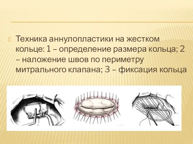 Техника аннулопластики на жестком кольце: 1 – определение размера кольца; 2 –