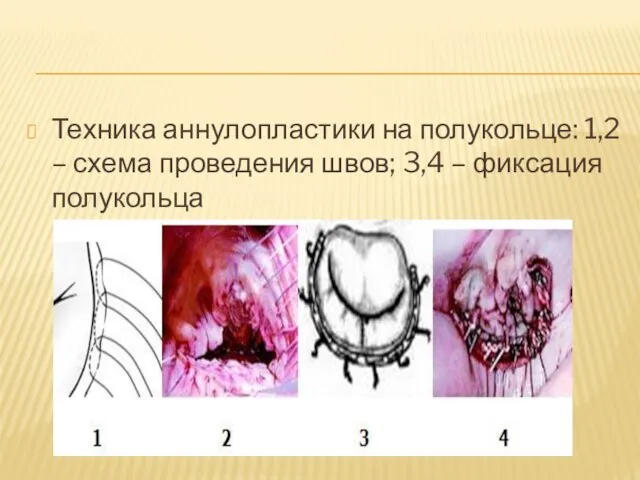 Техника аннулопластики на полукольце: 1,2 – схема проведения швов; 3,4 – фиксация полукольца