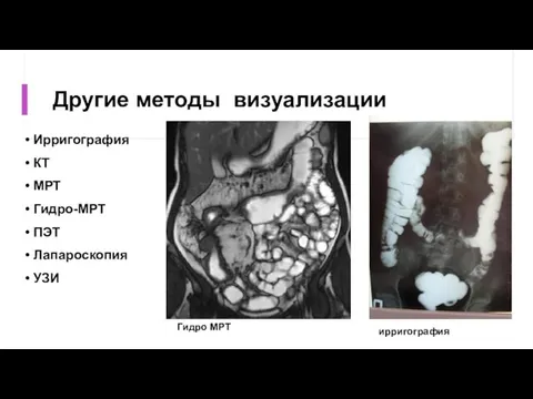 Другие методы визуализации Ирригография КТ МРТ Гидро-МРТ ПЭТ Лапароскопия УЗИ Гидро МРТ ирригография