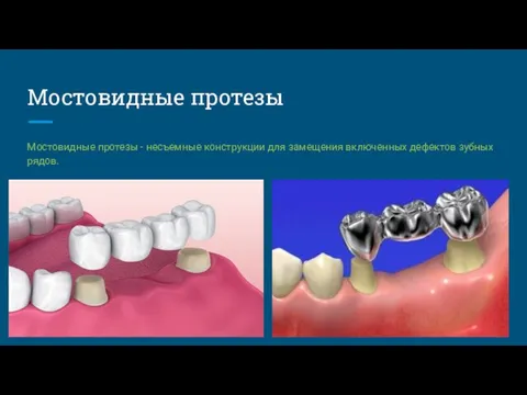 Мостовидные протезы Мостовидные протезы - несъемные конструкции для замещения включенных дефектов зубных рядов.
