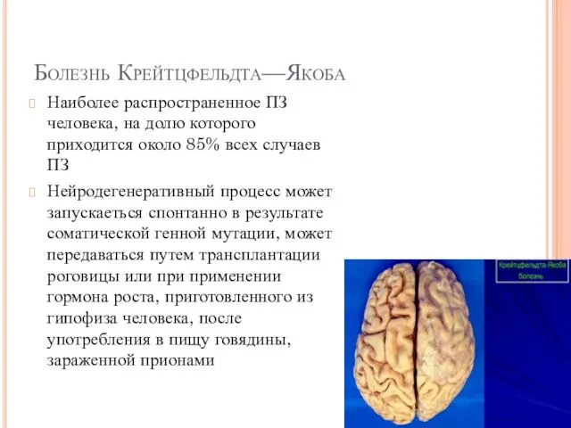 Болезнь Крейтцфельдта—Якоба Наиболее распространенное ПЗ человека, на долю которого приходится около 85%