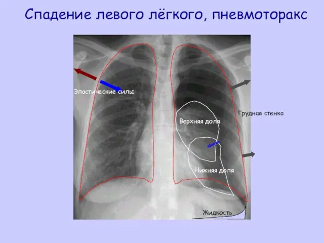 Спадение левого лёгкого, пневмоторакс Грудная стенка