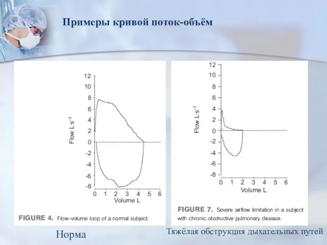 Примеры кривой поток-объём Норма Тяжёлая обструкция дыхательных путей