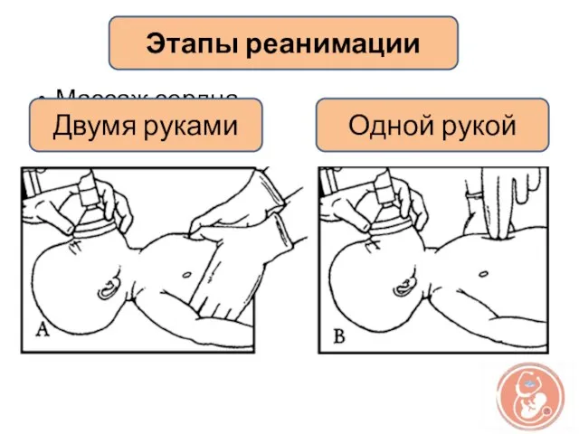 Массаж сердца Этапы реанимации Двумя руками Одной рукой