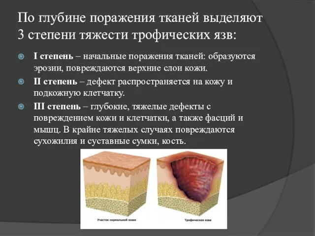 По глубине поражения тканей выделяют 3 степени тяжести трофических язв: I степень