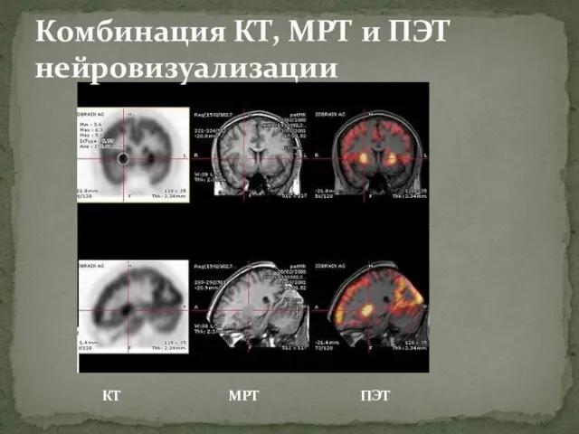 Комбинация КТ, МРТ и ПЭТ нейровизуализации КТ МРТ ПЭТ