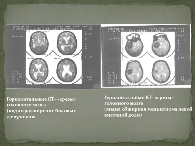 Горизонтальные КТ- «срезы» головного мозга (видно расширение боковых желудочков Горизонтальные КТ- «срезы»