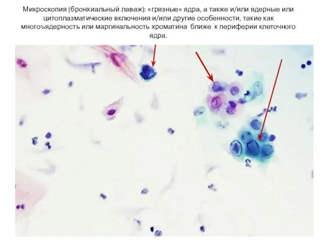 Микроскопия (бронхиальный лаваж): «грязные» ядра, а также и/или ядерные или цитоплазматические включения