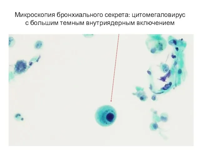 Микроскопия бронхиального секрета: цитомегаловирус с большим темным внутриядерным включением