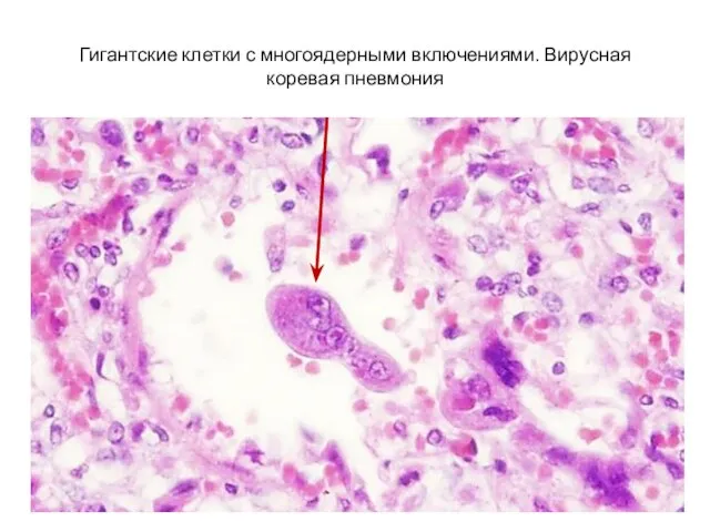 Гигантские клетки с многоядерными включениями. Вирусная коревая пневмония