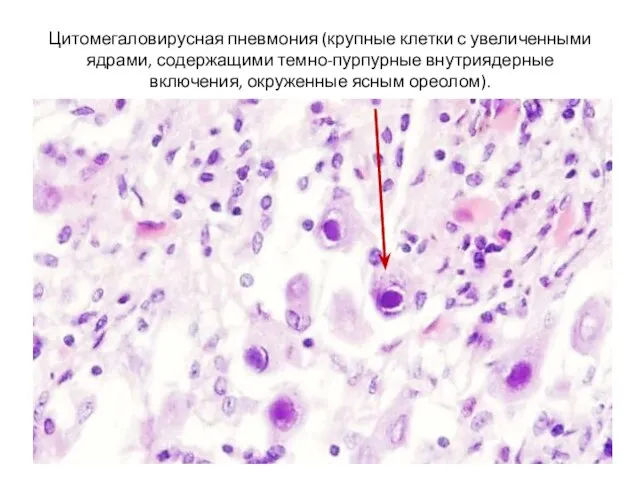 Цитомегаловирусная пневмония (крупные клетки с увеличенными ядрами, содержащими темно-пурпурные внутриядерные включения, окруженные ясным ореолом).
