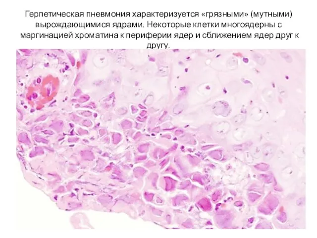 Герпетическая пневмония характеризуется «грязными» (мутными) вырождающимися ядрами. Некоторые клетки многоядерны с маргинацией