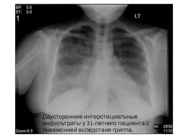 Двусторонние интерстициальные инфильтраты у 31-летнего пациента с пневмонией вследствие гриппа.