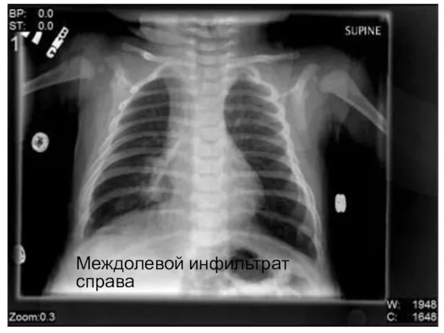 Междолевой инфильтрат справа