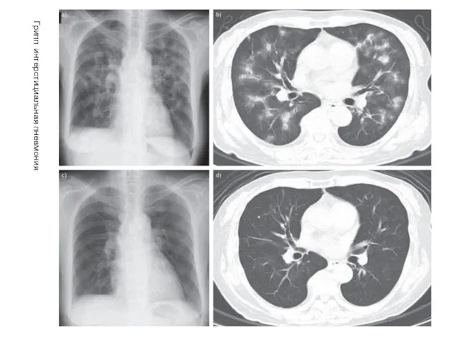 Грипп интерстициальная пневмония