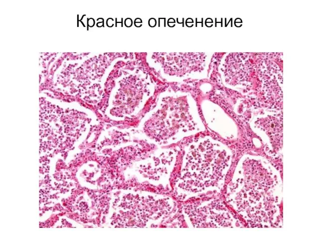 Красное опеченение