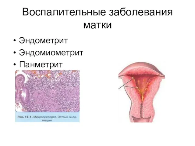 Воспалительные заболевания матки Эндометрит Эндомиометрит Панметрит