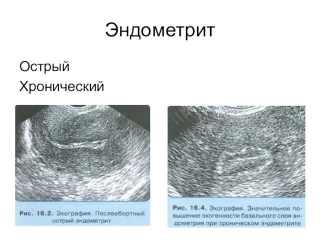 Эндометрит Острый Хронический