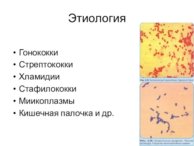 Этиология Гонококки Стрептококки Хламидии Стафилококки Миикоплазмы Кишечная палочка и др.