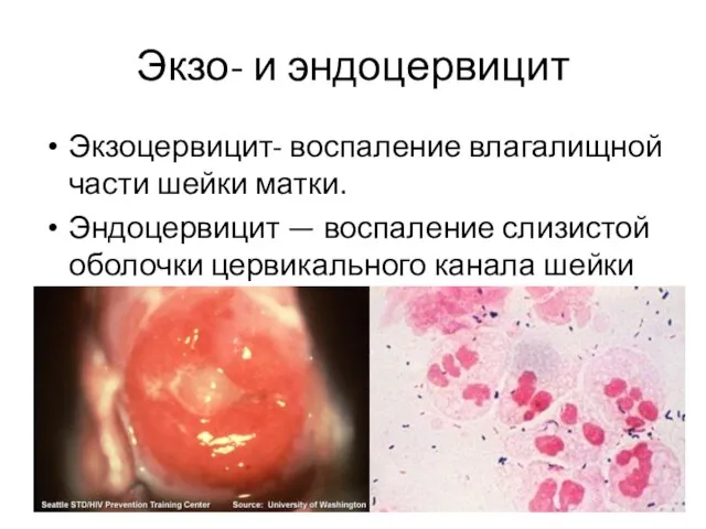Экзо- и эндоцервицит Экзоцервицит- воспаление влагалищной части шейки матки. Эндоцервицит — воспаление