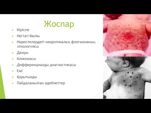 Жоспар Кіріспе Негізгі бөлім Нәрестелердегі некротикалық флегмонаның этиологиясы Дамуы Клиникасы Дифференциалды диагностикасы Емі Қорытынды Пайдаланылған әдебиеттер