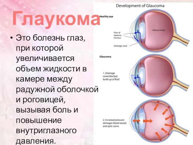 Глаукома Это болезнь глаз, при которой увеличивается объем жидкости в камере между