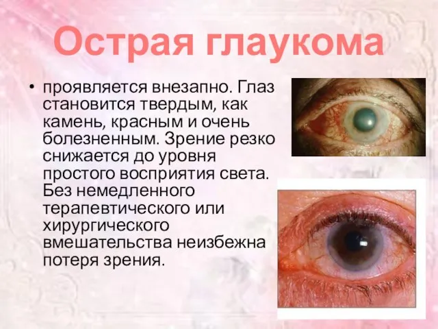 Острая глаукома проявляется внезапно. Глаз становится твердым, как камень, красным и очень