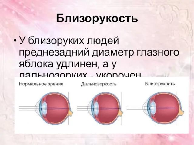 Близорукость У близоруких людей преднезадний диаметр глазного яблока удлинен, а у дальнозорких - укорочен