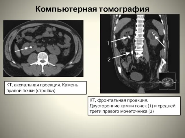 Компьютерная томография КТ, аксиальная проекция. Камень правой почки (стрелка) КТ, фронтальная проекция.