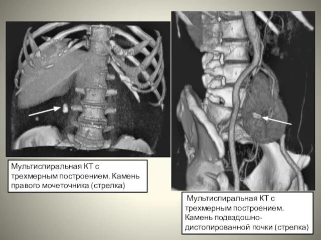 Мультиспиральная КТ с трехмерным построением. Камень правого мочеточника (стрелка) Мультиспиральная КТ с