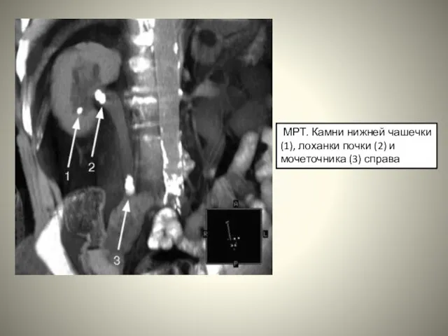 МРТ. Камни нижней чашечки (1), лоханки почки (2) и мочеточника (3) справа