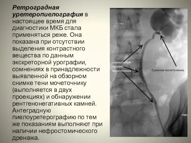 Ретроградная уретеропиелография в настоящее время для диагностики МКБ стала применяться реже. Она