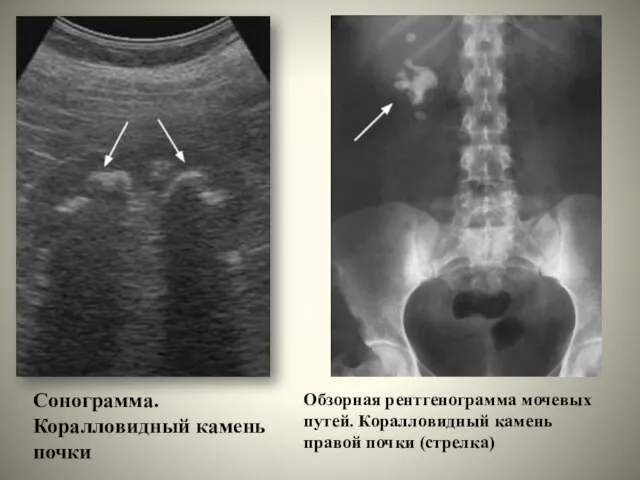 Сонограмма. Коралловидный камень почки Обзорная рентгенограмма мочевых путей. Коралловидный камень правой почки (стрелка)