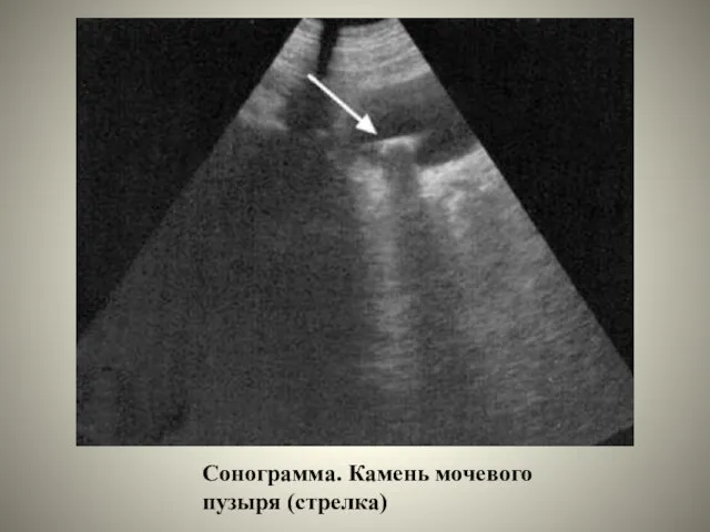Сонограмма. Камень мочевого пузыря (стрелка)
