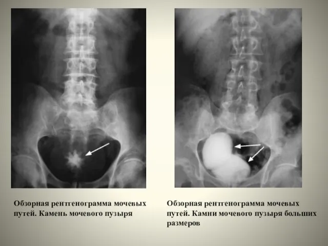 Обзорная рентгенограмма мочевых путей. Камень мочевого пузыря Обзорная рентгенограмма мочевых путей. Камни мочевого пузыря больших размеров