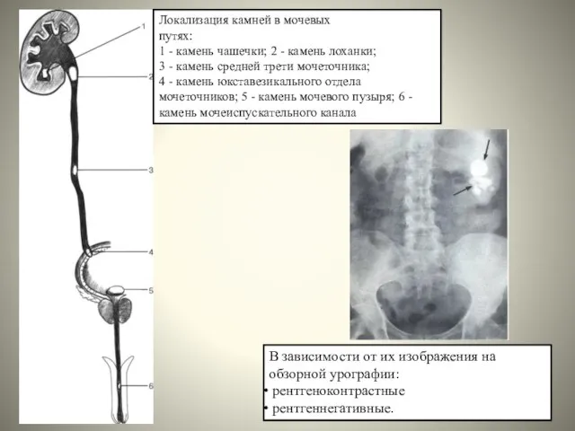 Локализация камней в мочевых путях: 1 - камень чашечки; 2 - камень