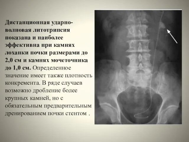 Дистанционная ударно-волновая литотрипсия показана и наиболее эффективна при камнях лоханки почки размерами