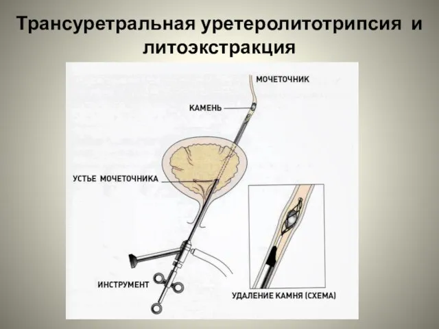 Трансуретральная уретеролитотрипсия и литоэкстракция