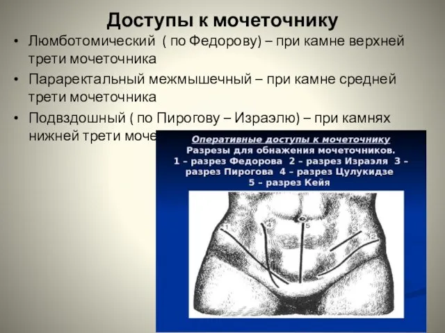 Доступы к мочеточнику Люмботомический ( по Федорову) – при камне верхней трети